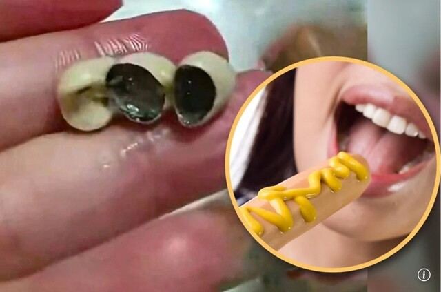 소세지·딤섬 속에 왜 ‘사람 치아’가?…중국 식품 속 이물질 발견 잇따라 ‘충격’